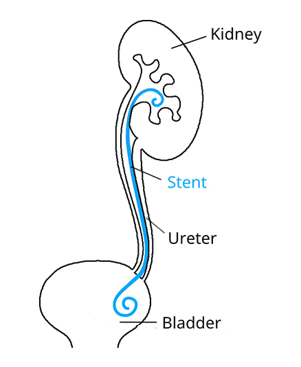 Stent ur&eacute;t&eacute;ral